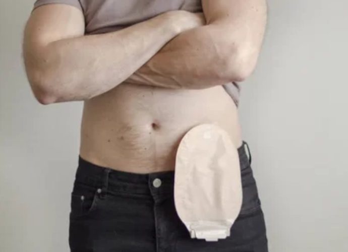 stoma