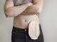 Life with a Stoma